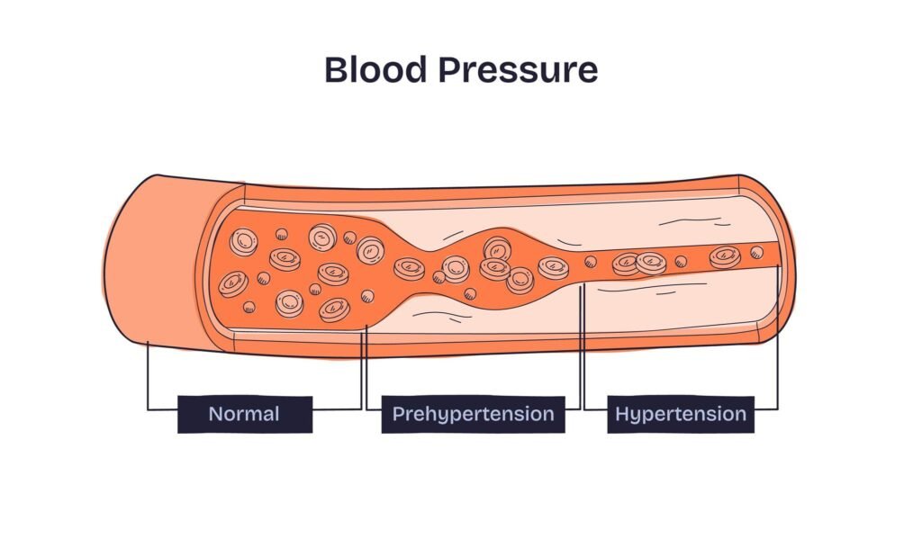 High Blood Pressure